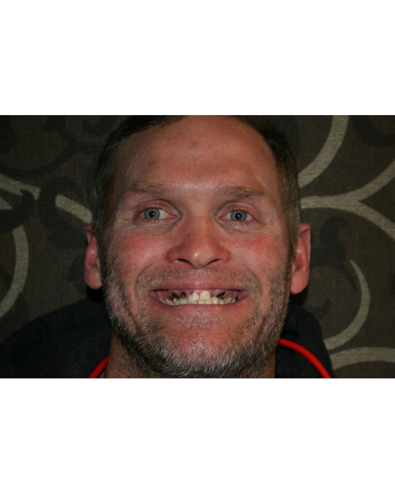 Casey before dental implant treatment - Highland IN patient