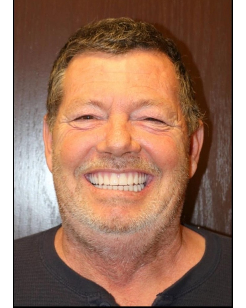 John after dental implant treatment - Highland IN results by Dr. Pulver