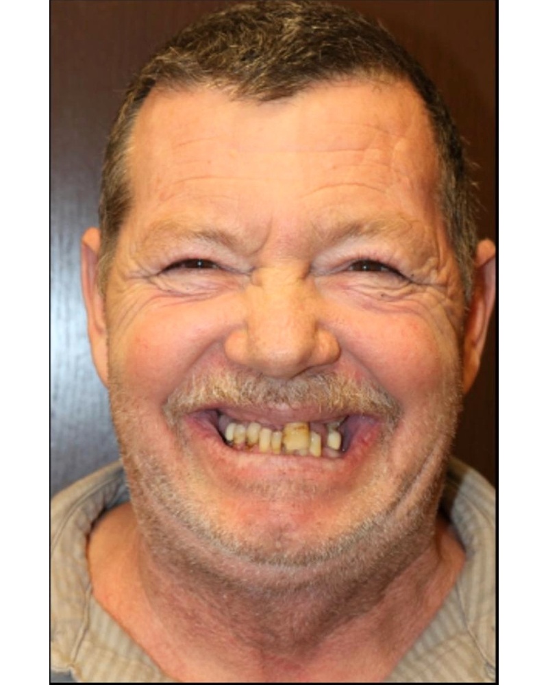 John before dental implant treatment - Highland IN patient