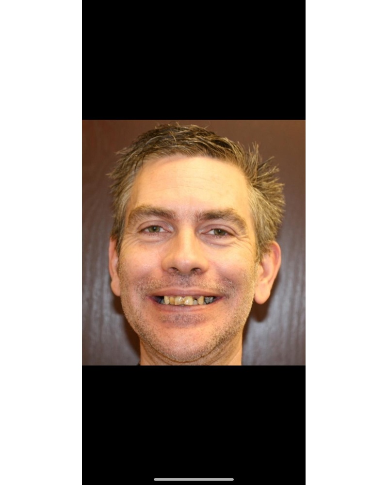 Mike before dental implant treatment - Highland IN patient