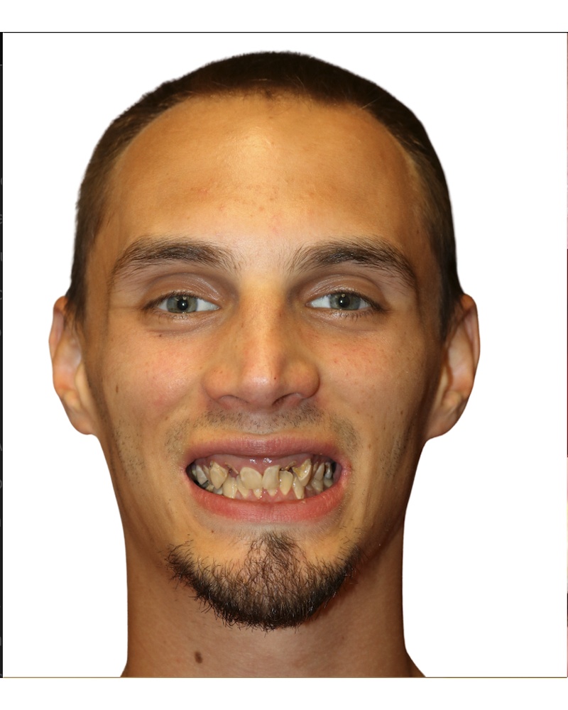 Nick before dental implant treatment - Highland IN patient