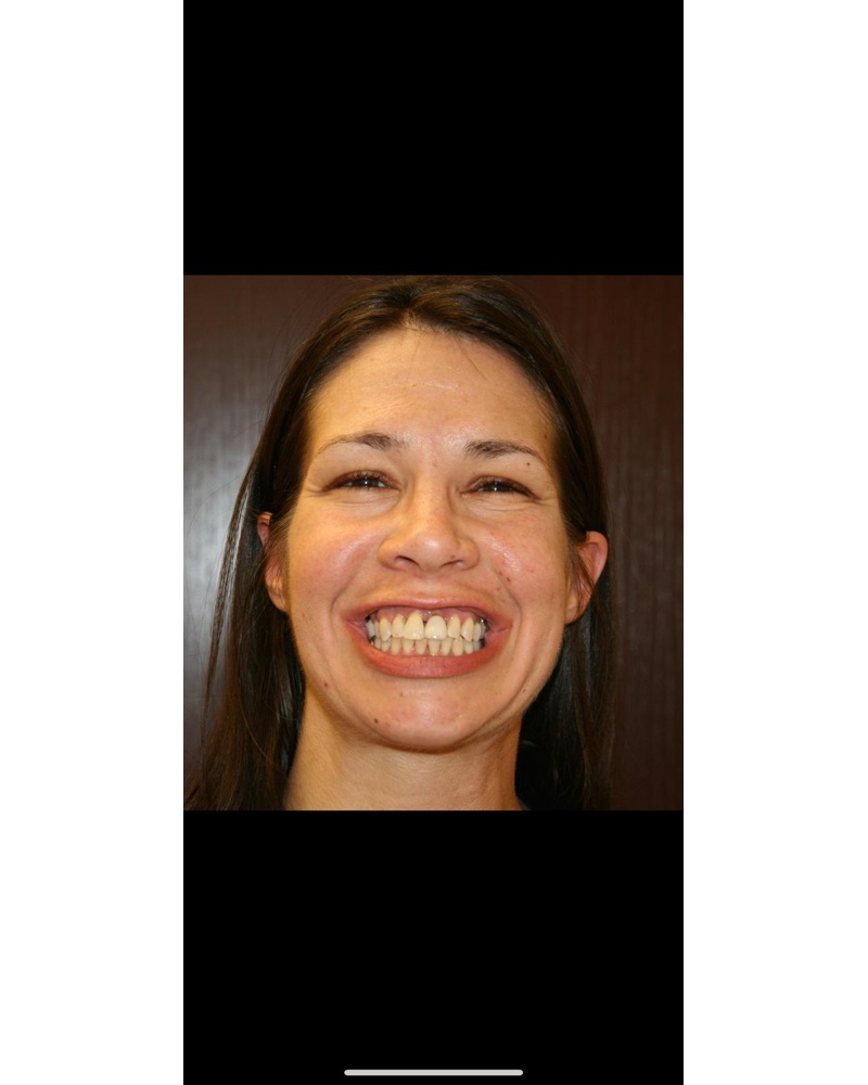 Sarah before dental implant treatment - Highland IN patient